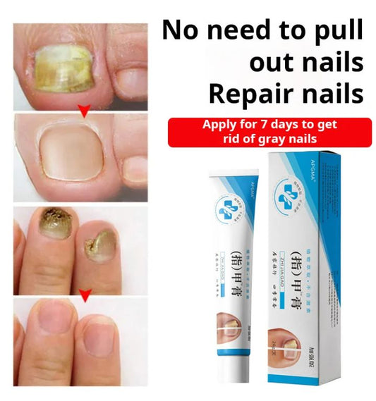 Fungal Nail Treatment Cream (BUY 1 GET 1 FREE)