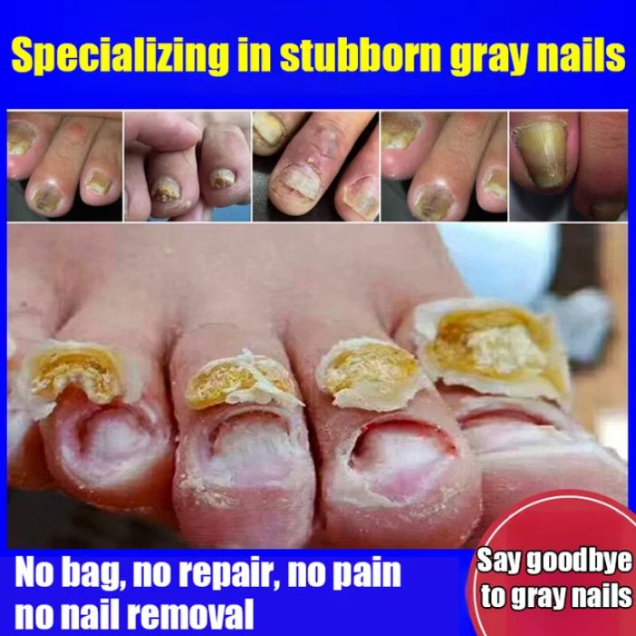 Fungal Nail Treatment Cream (BUY 1 GET 1 FREE)